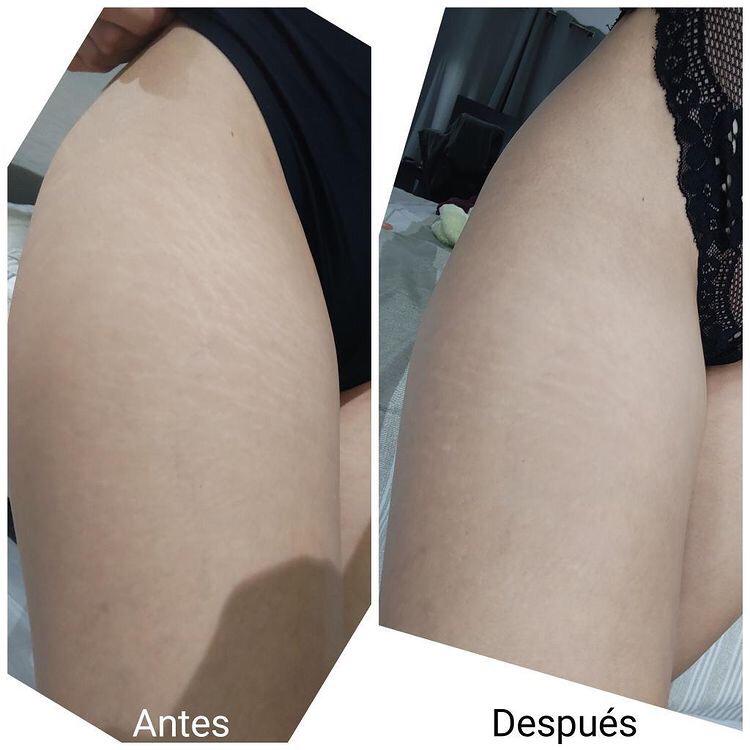 Dos Semanas a Piel Radiante: Cómo Nalguitas Bonitas Disimula Estrías y Mejora la Piel