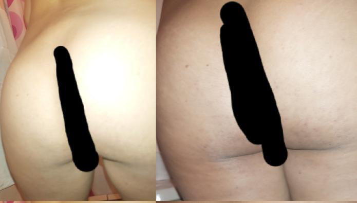 Menos de un Mes y Mi Piel está Suave y Sin Cicatrices!!