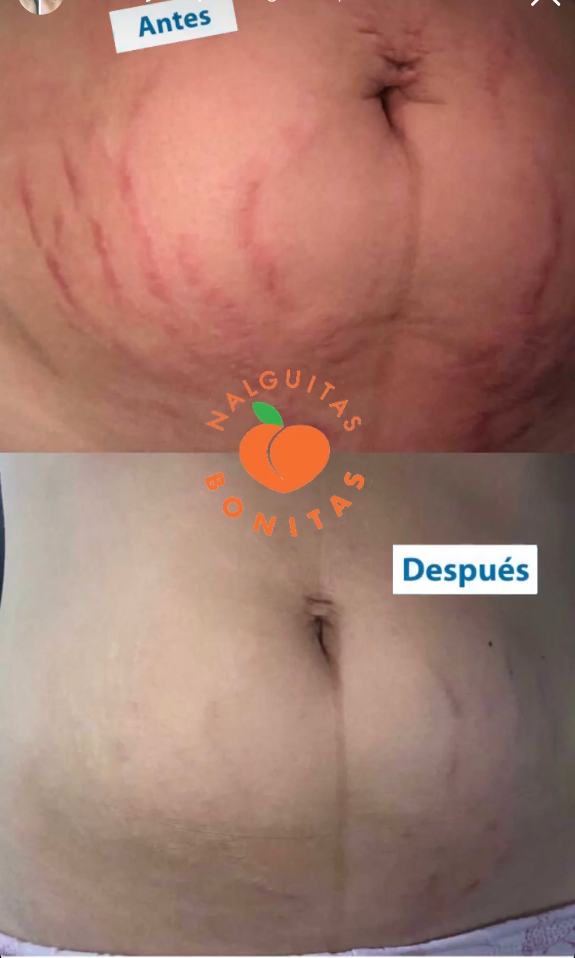 Transformación Post-Embarazo: Cómo Nalguitas Bonitas Atenuó Mis Estrías Rojas e Hinchadas
