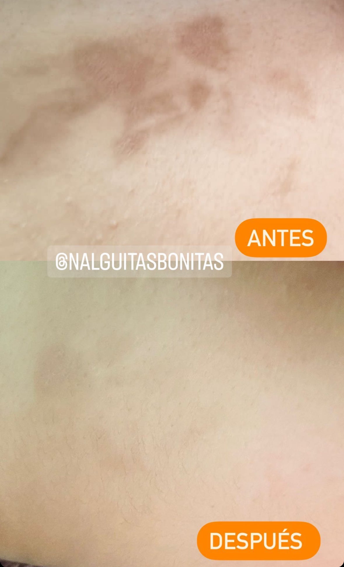 Transforma Tu Piel: Nalguitas Bonitas y su Efecto Aclarador Sorprendente
