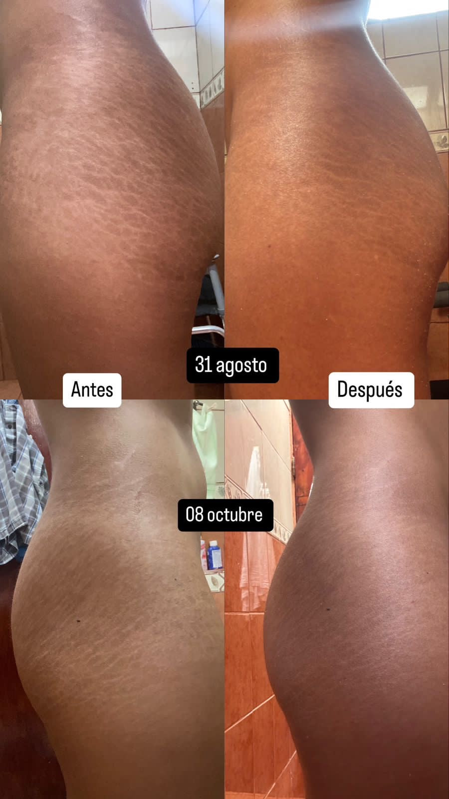 Cómo Nalguitas Bonitas Eliminó Mis Estrías y Cambió Mi Vida
