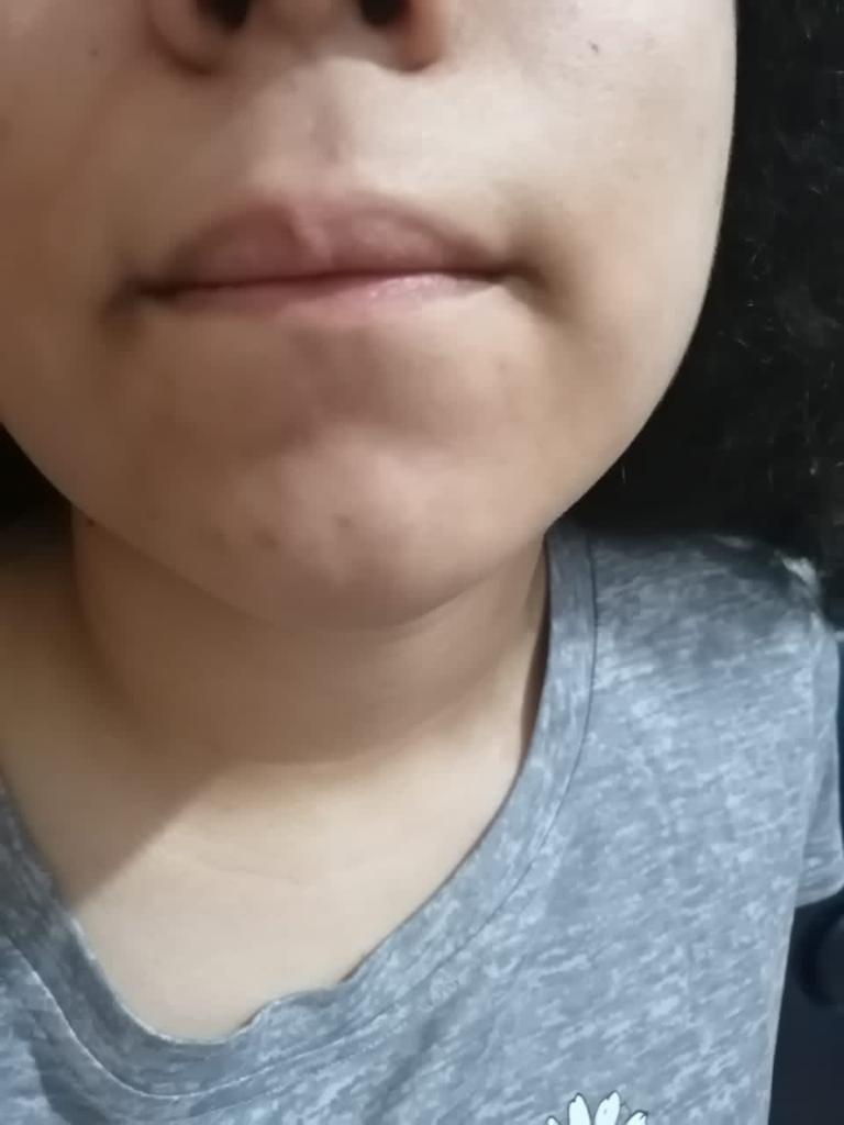 Nalguitas Bonitas: Un Antes y Después Impresionante en el Tratamiento de Manchas Faciales